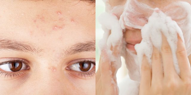 「洗澡同时洗脸较容易长痘痘，真的吗？」用冷水缩毛孔？皮肤科医师完整解答 美美日记,meimeiriji.com
