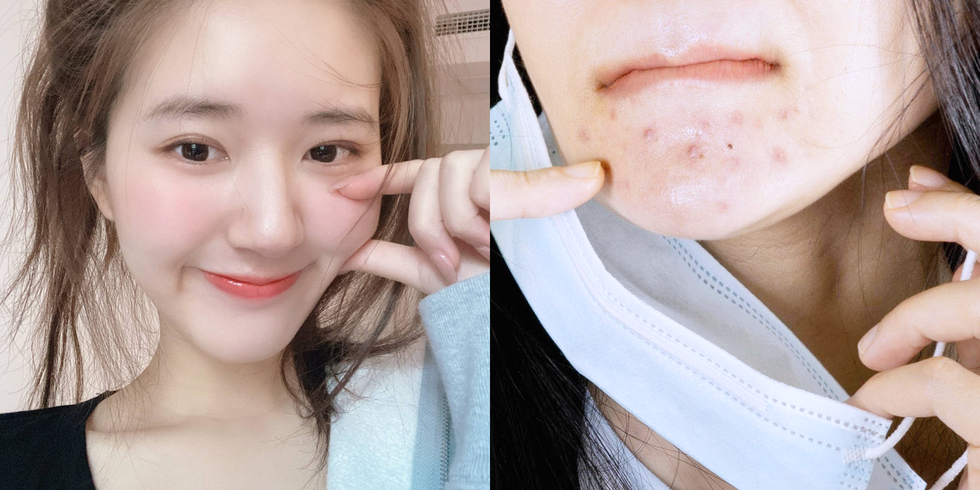 椰子油可以去黑头？5步骤「超温和去黑头方法」搭配按摩手法、收敛毛孔…这样做轻松不留疤～ 美美日记,meimeiriji.com